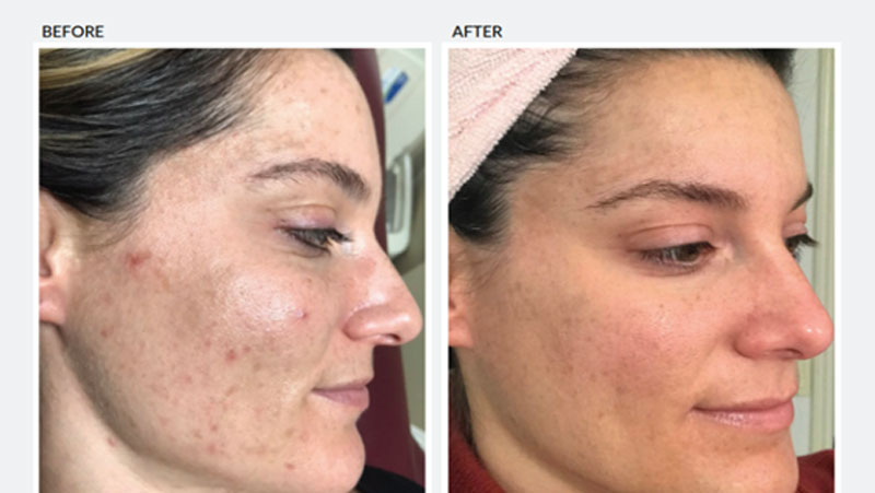 Peel Treatment results