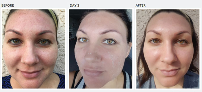 phases of peel treatment