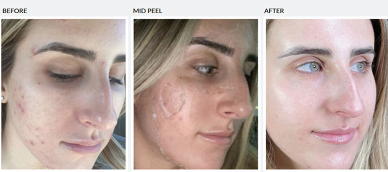 Before mid and after-peel treatment